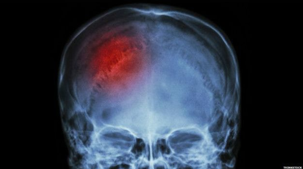 Como identificar os primeiros sintomas de derrame cerebral